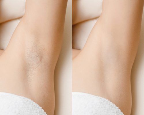 Women underarm hair removal. Concept before and after shaving laser